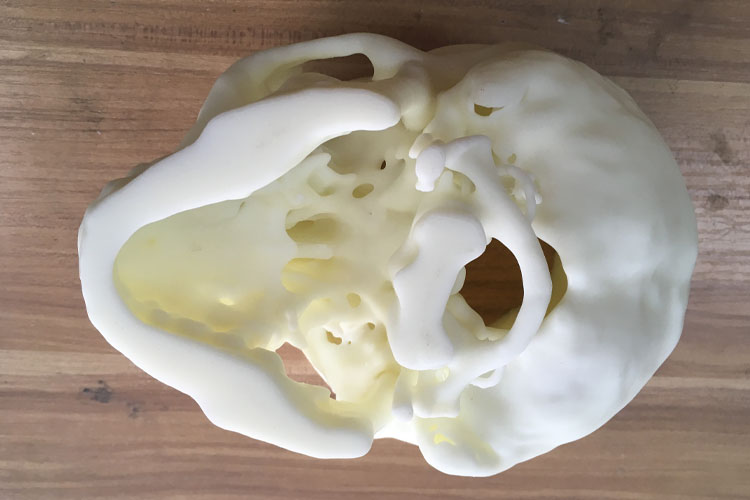 SLA 3D printing technology in the medical field: How to choose a suitable medical 3D printer